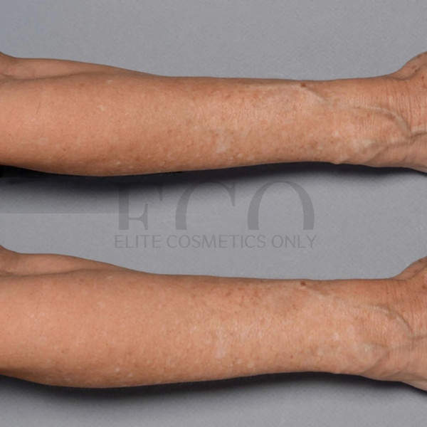 Антивозрастной крем для тела Perricone MD Cold Plasma Plus Fragile Skin Therapy, 177 мл